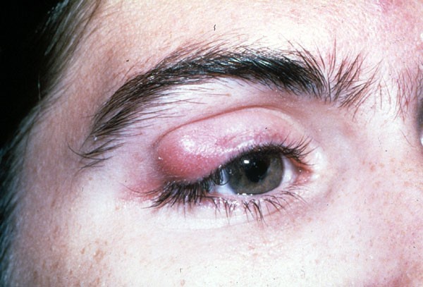 Nodule deals on eyelid