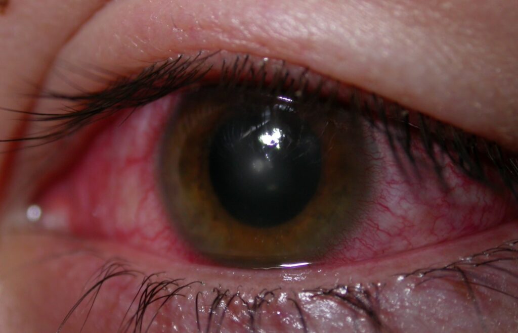 abrasion corneal erosion ulcer opacity centrally