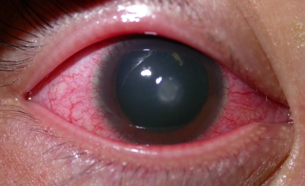 corneal ulcer scar