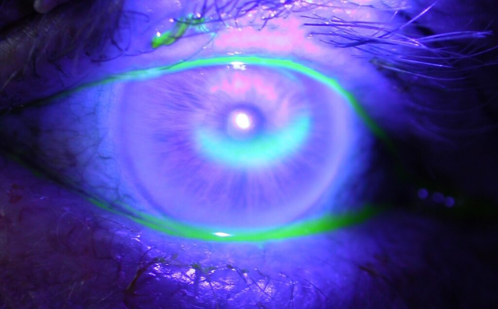 scleral abrasion fluorescein