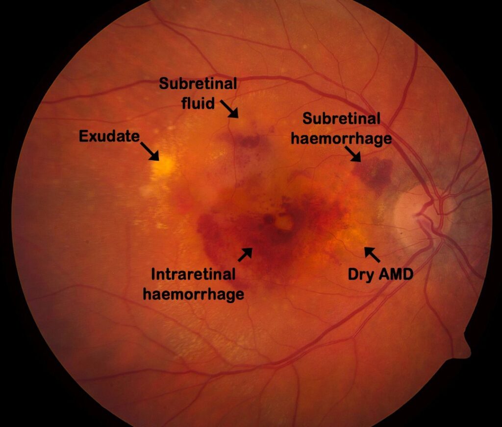 dry vs wet macular degeneration