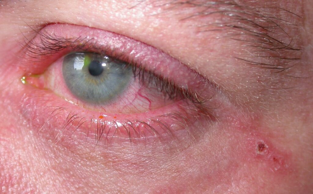 my eyes has been stained pinkish and yellowish like this since