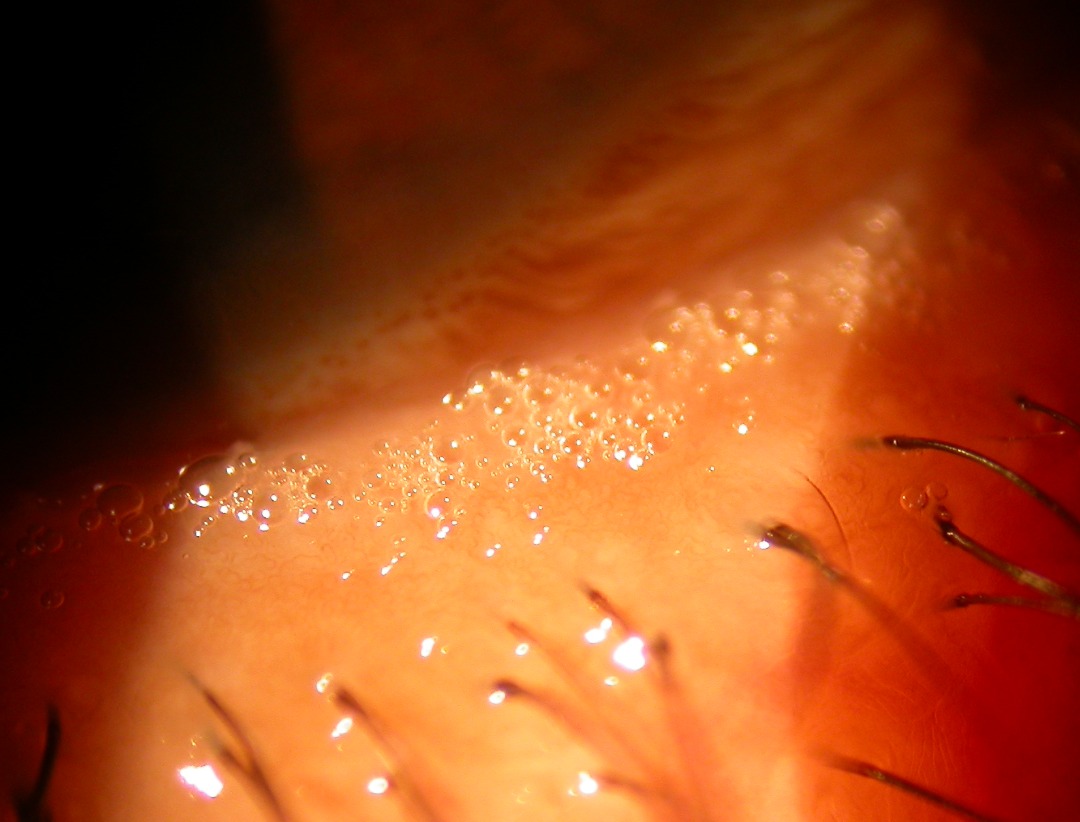 Blepharitis Eye Surgery LTD