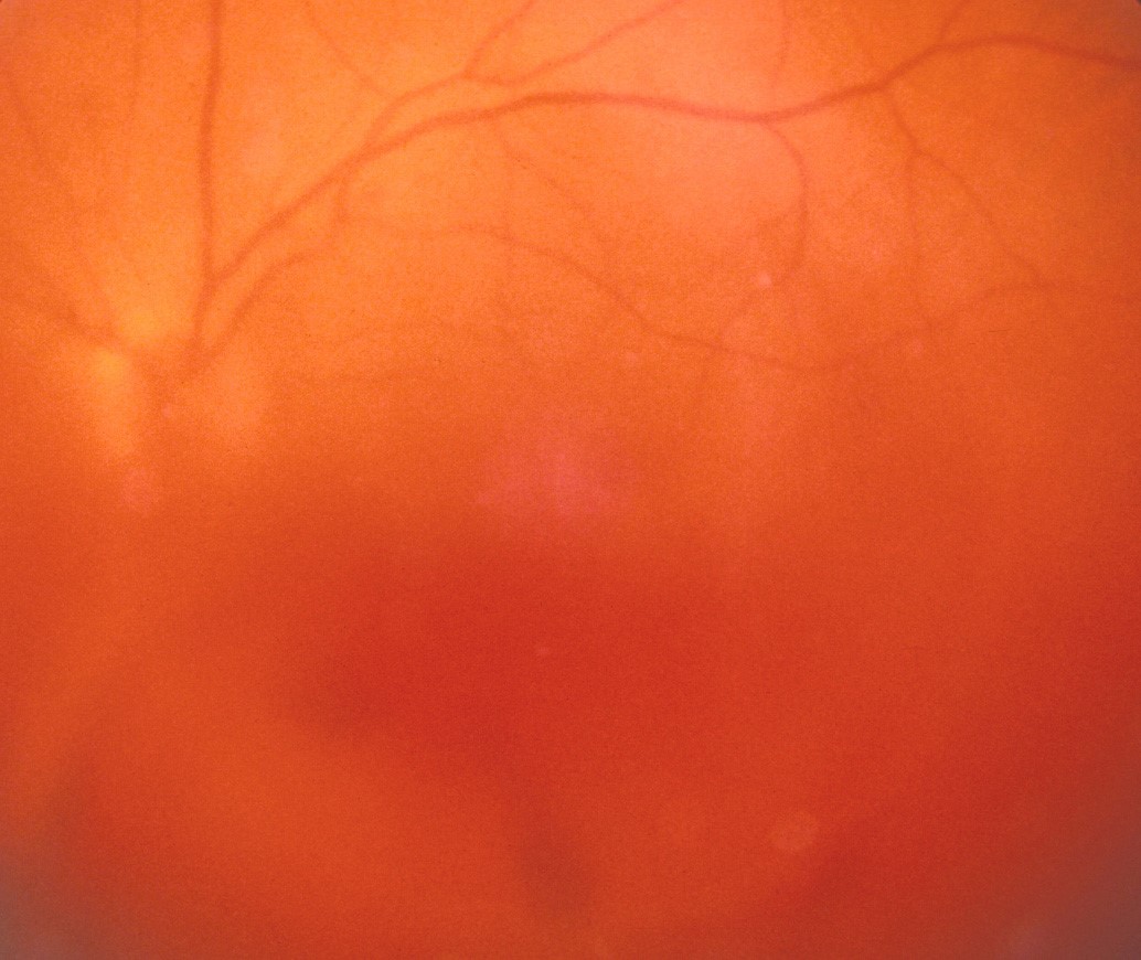 Vitreous Haemorrhage Eye Surgery LTD