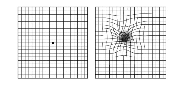 Age-Related Changes (Drusen & Macular Degeneration) - Eye Surgery LTD