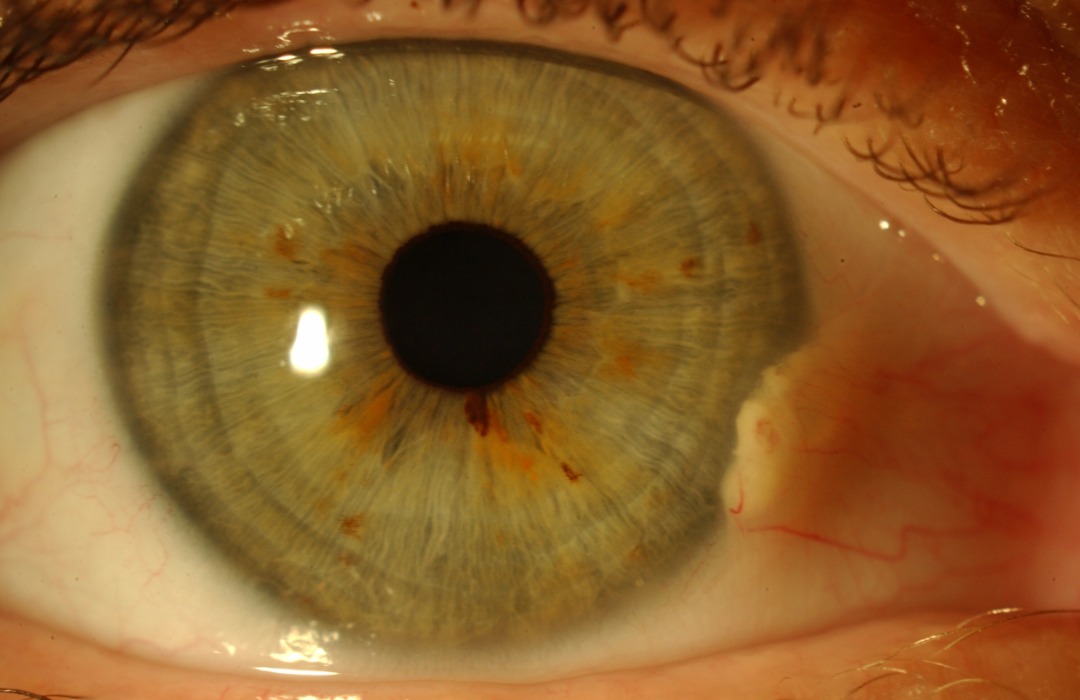 Growth (Pterygium, Pingueculum, Neavus) Eye Surgery LTD