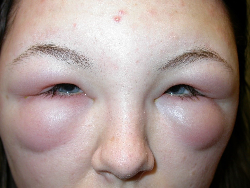 conjunctivitis-allergic-infective-eye-surgery-ltd