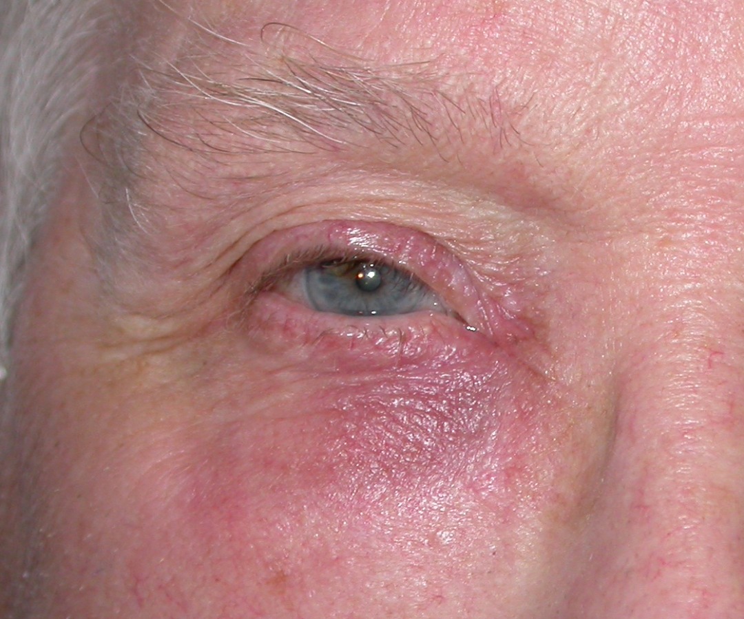 Lid lump (Stye, Chalazion, Carcinoma) - Eye Surgery LTD