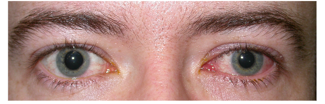 allergic conjunctivitis discharge